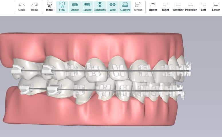 3D printed braces Rehil Orthodontics in Woodland Hills, CA