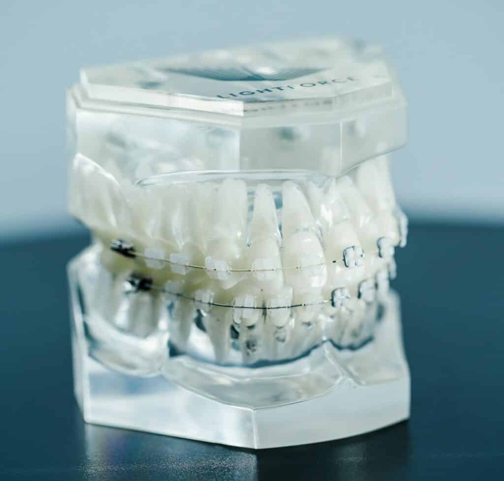 3D printed braces Rehil Orthodontics in Woodland Hills, CA