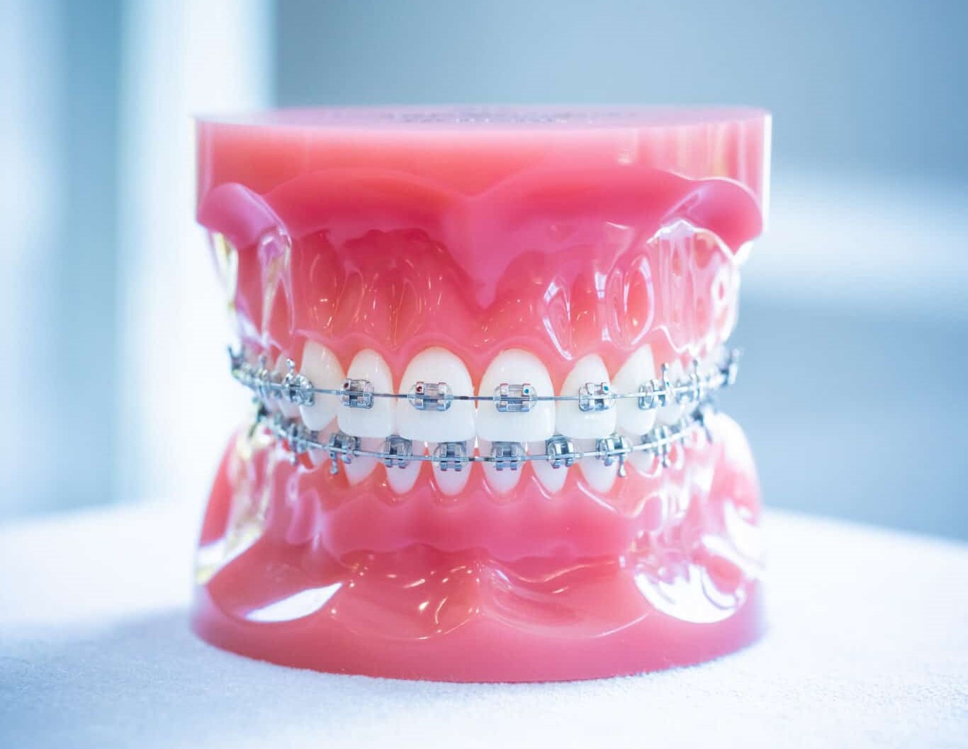 Types of braces Woodland Hills CA Rehil Orthodontics